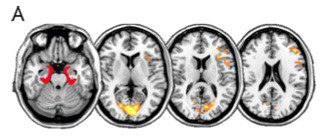Areas in yellow show increased connection with the parahippocampus. There’s most in the condition of LSD with music, then LSD without music, then placebo with music. Image: M. Kaelen et al, European Neuropsychopharmacology