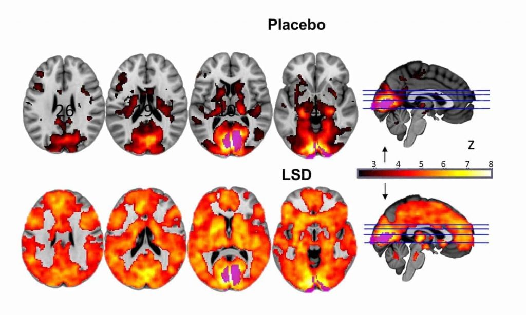 The top row shows a normal brain; the bottom shows a brain on LSD (note the orange flares of activity).